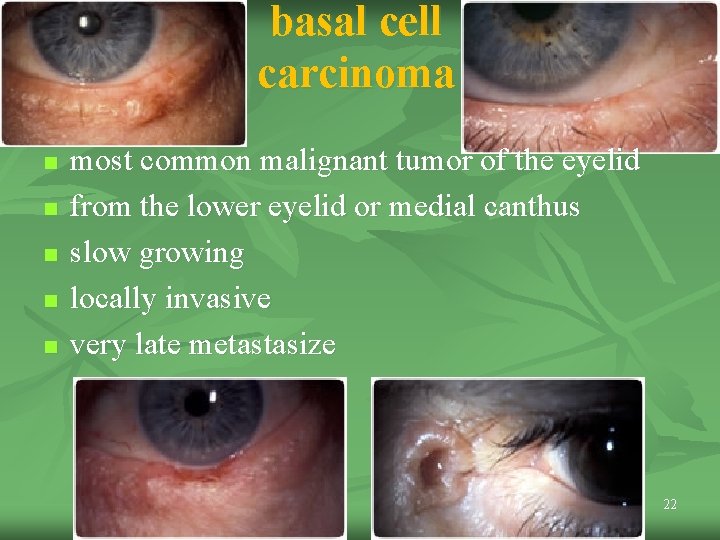 basal cell carcinoma n n n most common malignant tumor of the eyelid from basal cell carcinoma n n n most common malignant tumor of the eyelid from