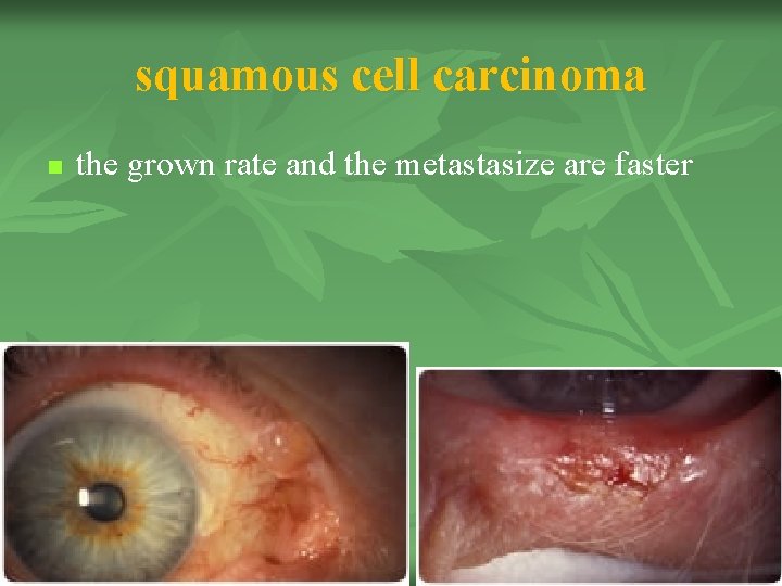 squamous cell carcinoma n the grown rate and the metastasize are faster 23 