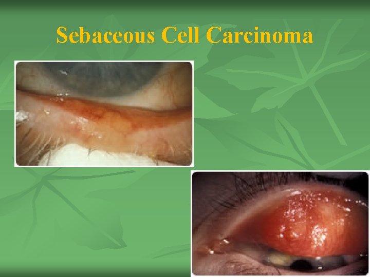 Sebaceous Cell Carcinoma n . 24 