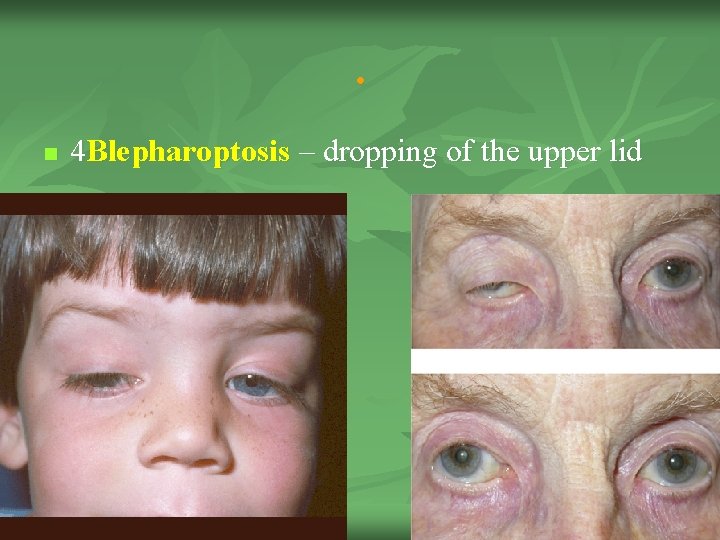 . n 4 Blepharoptosis – dropping of the upper lid 4 