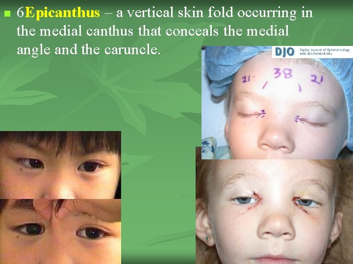 n 6 Epicanthus – a vertical skin fold occurring in the medial canthus that