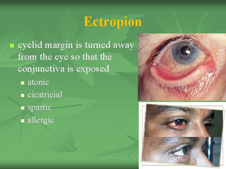 Ectropion n eyelid margin is turned away from the eye so that the conjunctiva