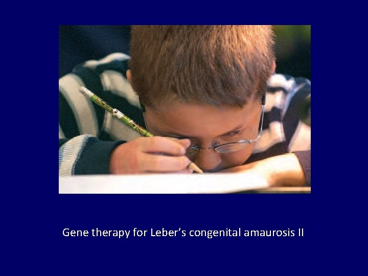 Gene therapy for Leber’s congenital amaurosis II 