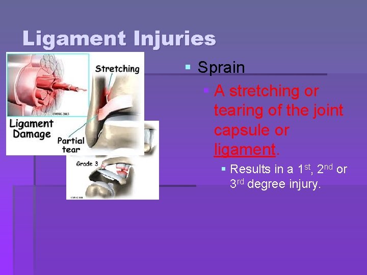 Ligament Injuries § Sprain § A stretching or tearing of the joint capsule or Ligament Injuries § Sprain § A stretching or tearing of the joint capsule or