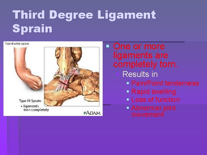 Third Degree Ligament Sprain § One or more ligaments are completely torn. § Results Third Degree Ligament Sprain § One or more ligaments are completely torn. § Results