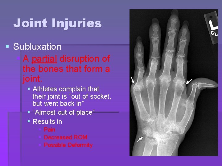 Joint Injuries § Subluxation § A partial disruption of the bones that form a Joint Injuries § Subluxation § A partial disruption of the bones that form a