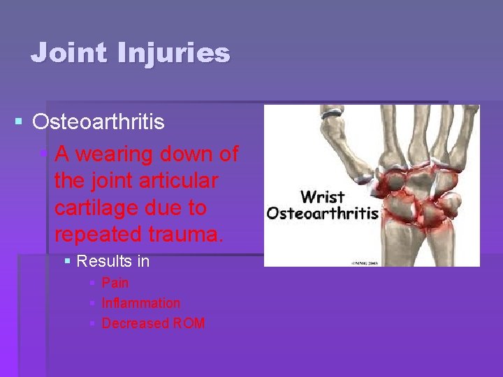 Joint Injuries § Osteoarthritis § A wearing down of the joint articular cartilage due Joint Injuries § Osteoarthritis § A wearing down of the joint articular cartilage due