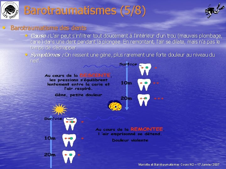 Barotraumatismes (5/8) • Barotraumatisme des dents • Cause : L’air peut s’infiltrer tout doucement
