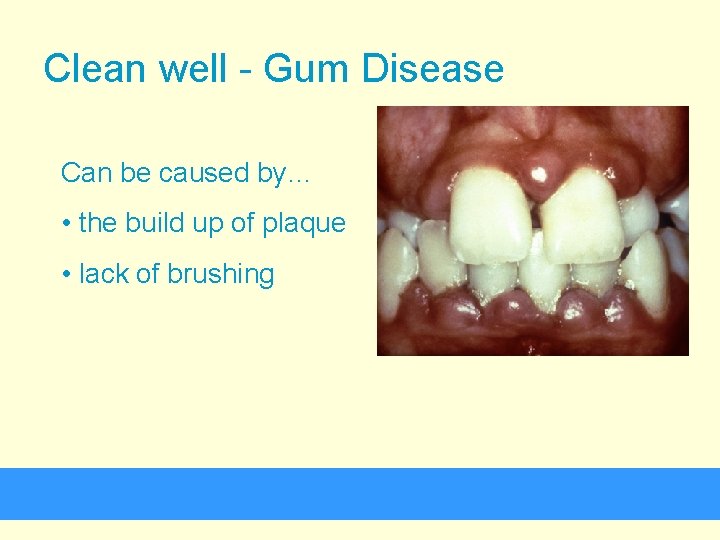 Clean well - Gum Disease Can be caused by… • the build up of