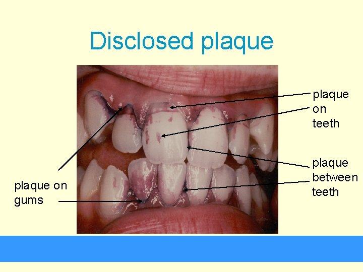 Disclosed plaque on teeth plaque on gums plaque between teeth 