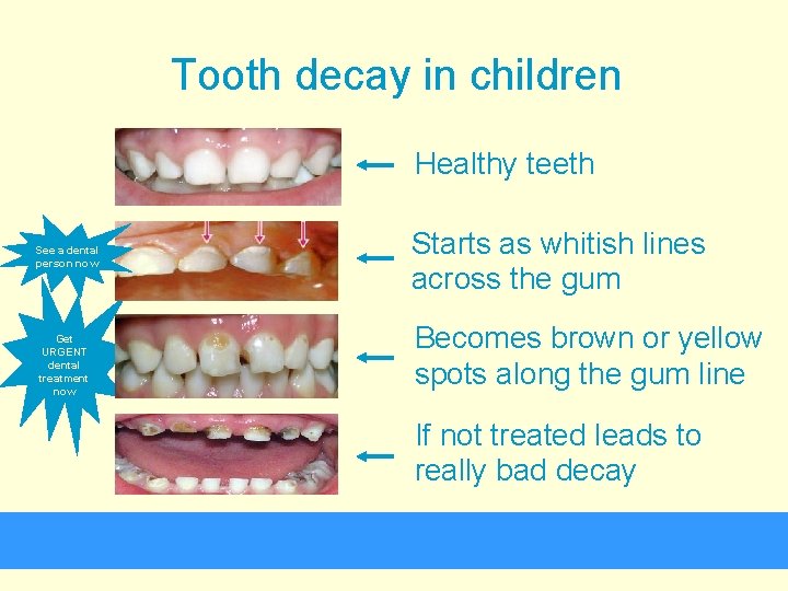 Tooth decay in children Healthy teeth See a dental person now Get URGENT dental