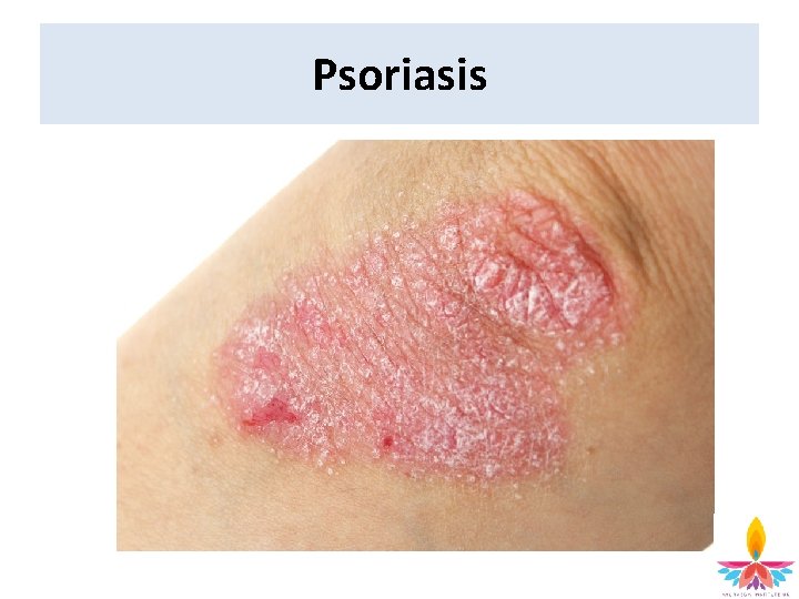 Psoriasis 