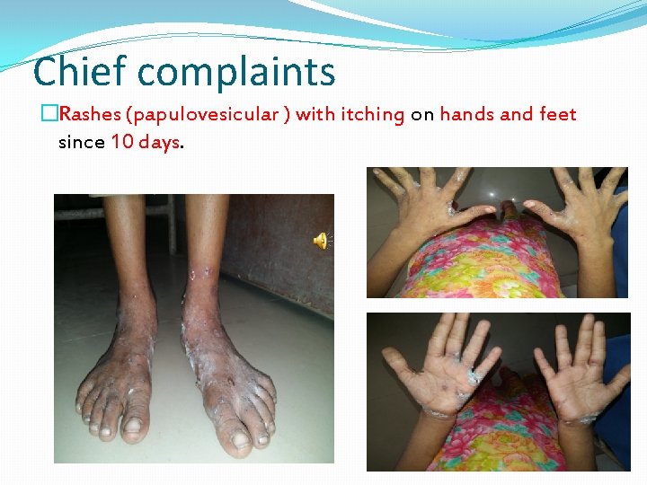 Chief complaints �Rashes (papulovesicular ) with itching on hands and feet since 10 days.