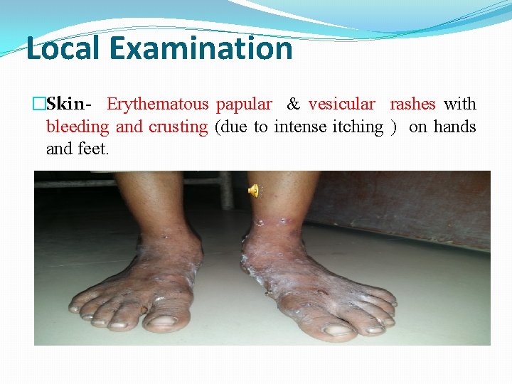 Local Examination �Skin- Erythematous papular & vesicular rashes with bleeding and crusting (due to