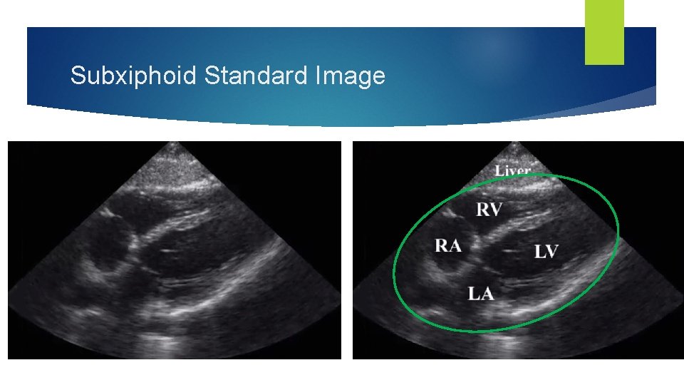 Subxiphoid Standard Image 