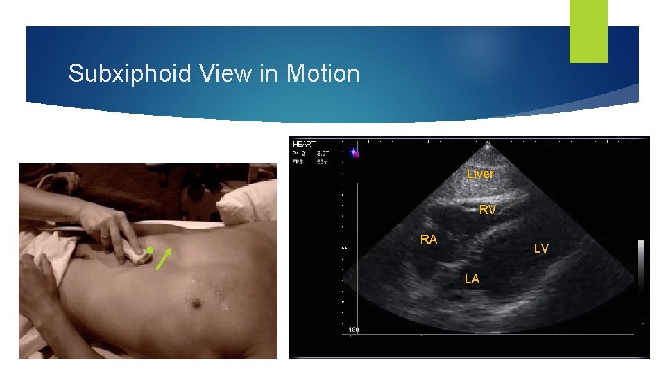 Subxiphoid View in Motion Liver RV RA LV LA 