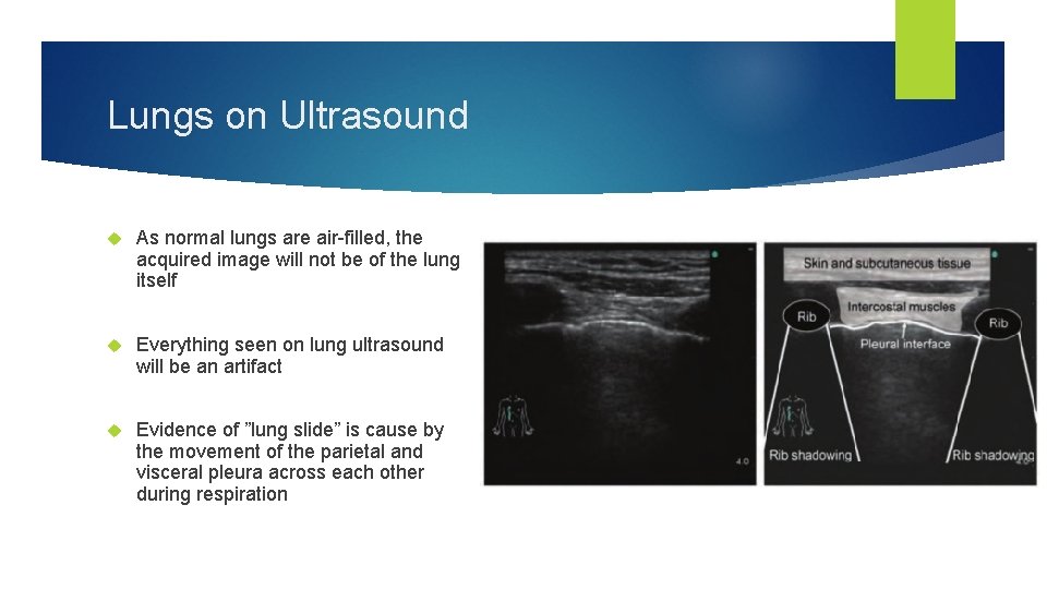 Lungs on Ultrasound As normal lungs are air-filled, the acquired image will not be