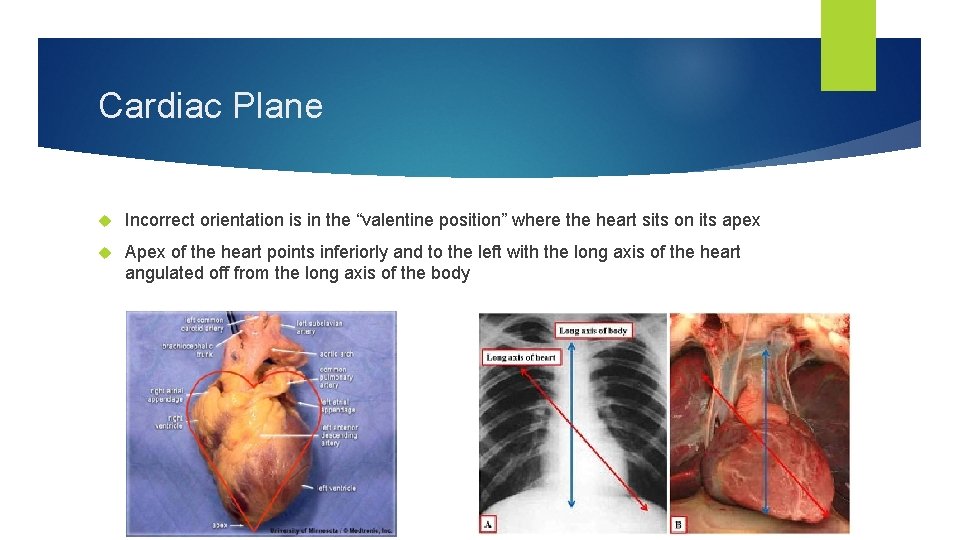 Cardiac Plane Incorrect orientation is in the “valentine position” where the heart sits on