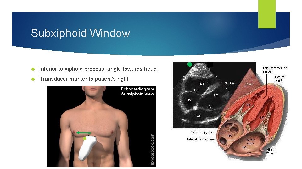 Subxiphoid Window Inferior to xiphoid process, angle towards head Transducer marker to patient's right