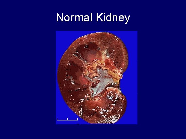 Normal Kidney 