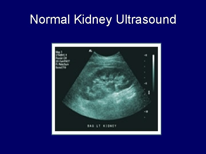 Normal Kidney Ultrasound 
