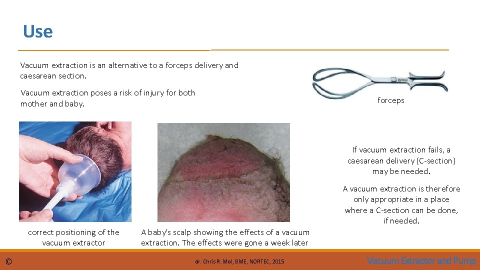 Use Vacuum extraction is an alternative to a forceps delivery and caesarean section. Vacuum