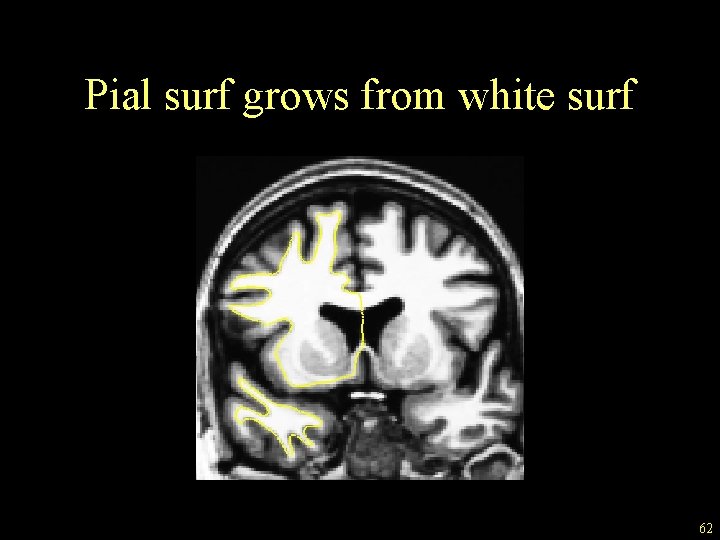 Pial surf grows from white surf 62 