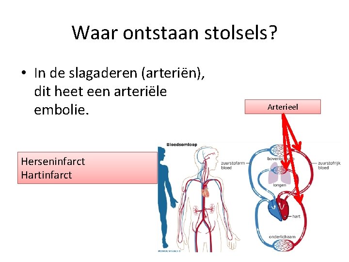 Waar ontstaan stolsels? • In de slagaderen (arteriën), dit heet een arteriële embolie. Herseninfarct