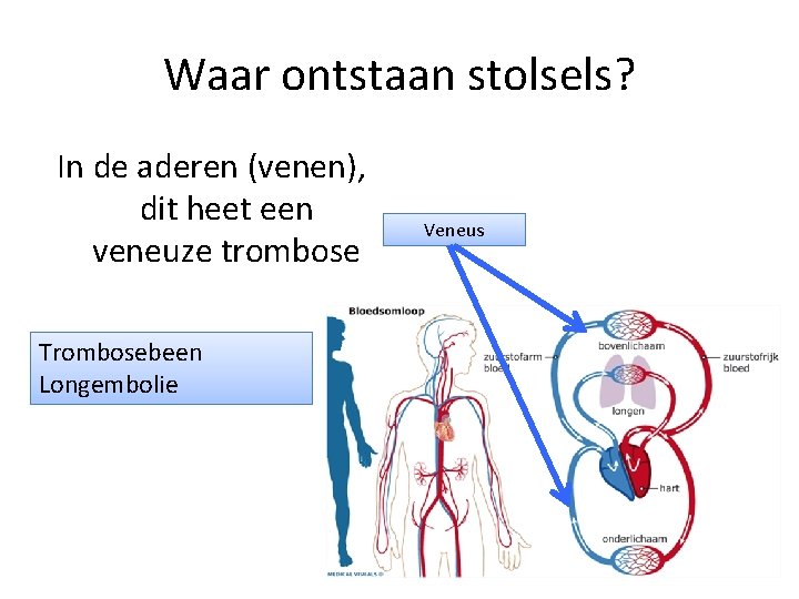 Waar ontstaan stolsels? In de aderen (venen), dit heet een veneuze trombose Trombosebeen Longembolie