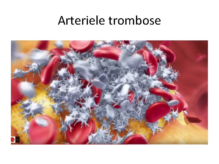 Arteriele trombose 