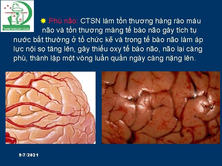  Phù não: CTSN làm tổn thương hàng rào máu não và tổn thương