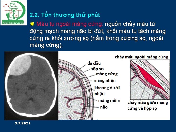 2. 2. Tổn thương thứ phát Máu tụ ngoài màng cứng: nguồn chảy máu