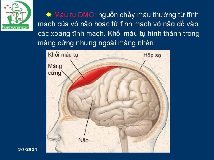  Máu tụ DMC: nguồn chảy máu thường từ tĩnh mạch của vỏ não