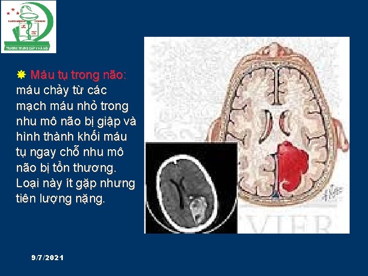  Máu tụ trong não: máu chảy từ các mạch máu nhỏ trong nhu