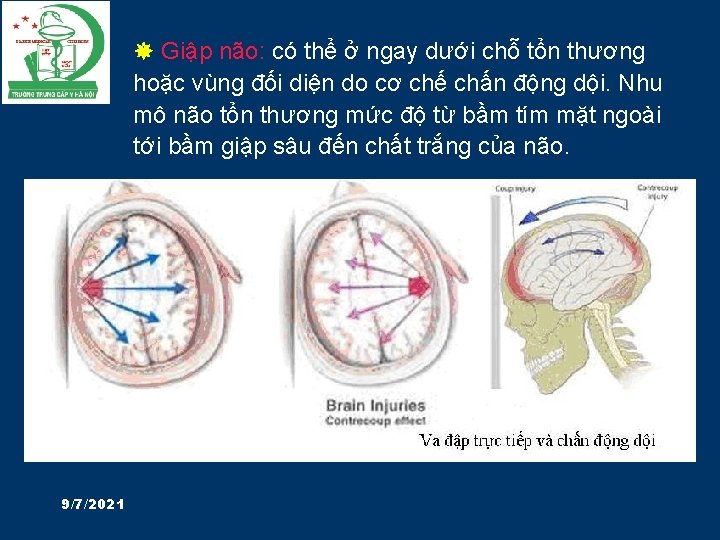  Giập não: có thể ở ngay dưới chỗ tổn thương hoặc vùng đối