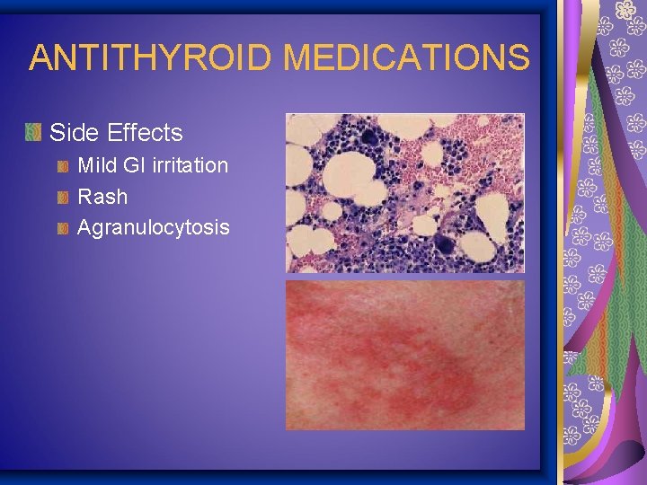 ANTITHYROID MEDICATIONS Side Effects Mild GI irritation Rash Agranulocytosis 