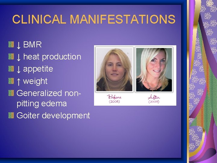 CLINICAL MANIFESTATIONS ↓ BMR ↓ heat production ↓ appetite ↑ weight Generalized nonpitting edema