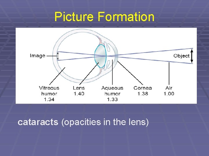 Picture Formation cataracts (opacities in the lens) 