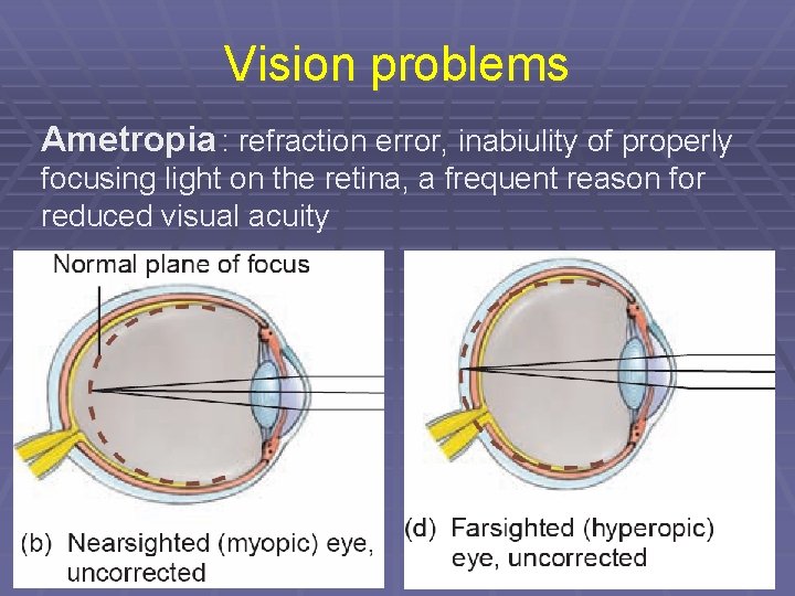 Vision problems Ametropia : refraction error, inabiulity of properly focusing light on the retina,