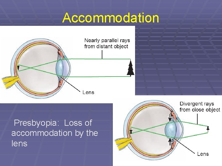 Accommodation Presbyopia: Loss of accommodation by the lens 