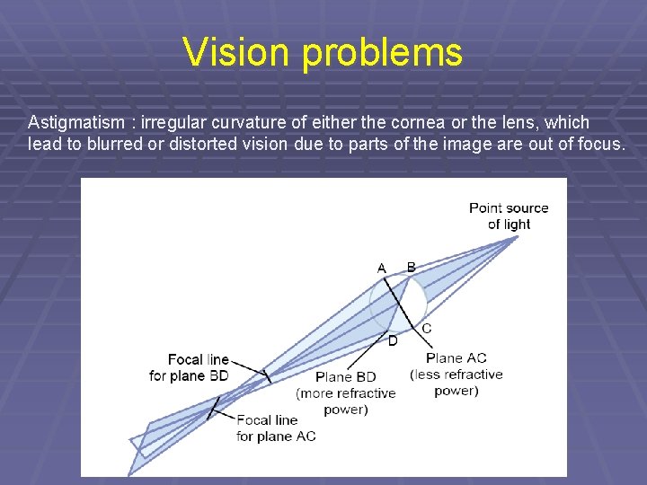 Vision problems Astigmatism : irregular curvature of either the cornea or the lens, which