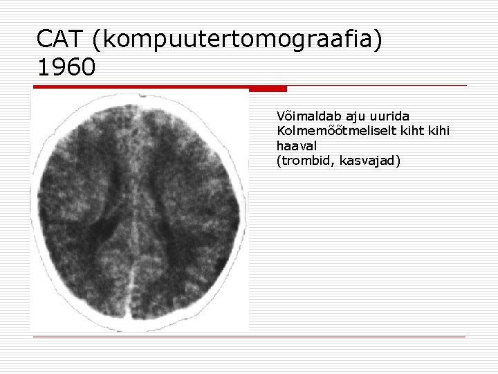 CAT (kompuutertomograafia) 1960 Võimaldab aju uurida Kolmemõõtmeliselt kihi haaval (trombid, kasvajad) 