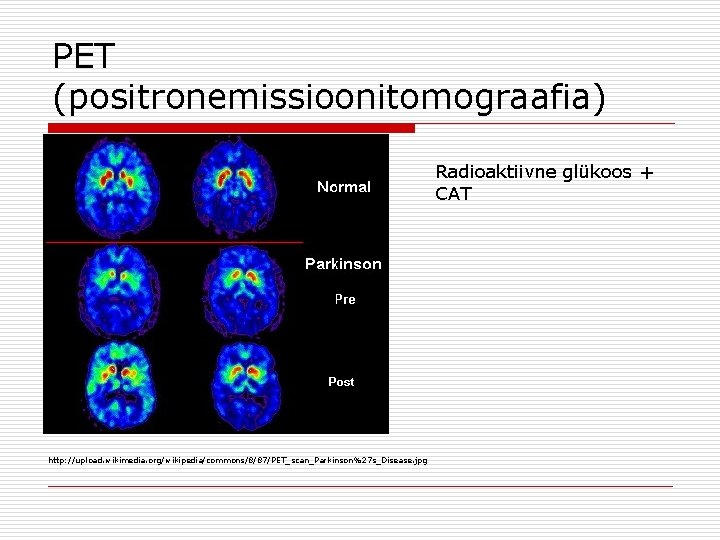 PET (positronemissioonitomograafia) Radioaktiivne glükoos + CAT http: //upload. wikimedia. org/wikipedia/commons/8/87/PET_scan_Parkinson%27 s_Disease. jpg 