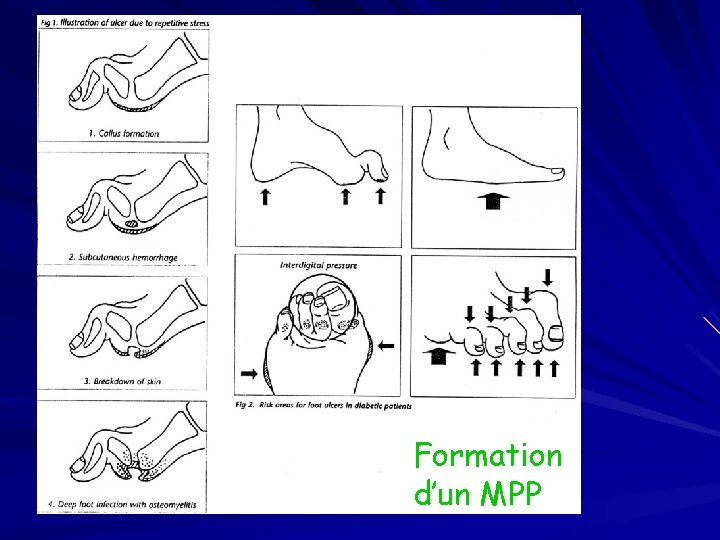 Formation d’un MPP 