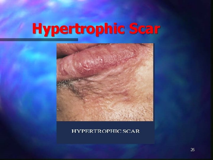 Hypertrophic Scar 26 