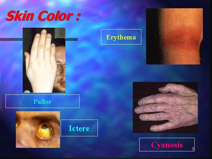 Skin Color : Erythema Pallor Ictere Cyanosis 3 