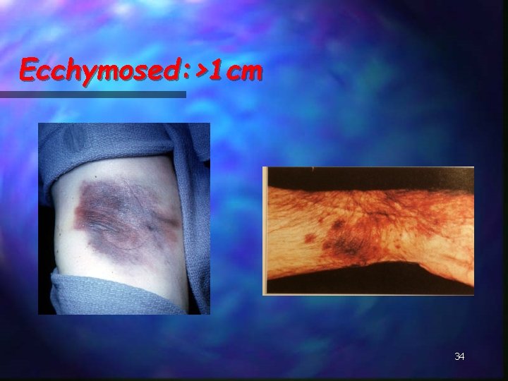 Ecchymosed: >1 cm 34 