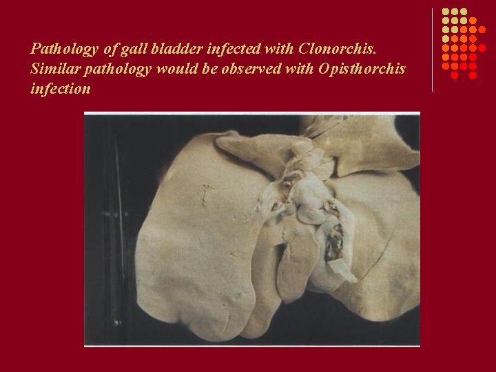 Pathology of gall bladder infected with Clonorchis. Similar pathology would be observed with Opisthorchis Pathology of gall bladder infected with Clonorchis. Similar pathology would be observed with Opisthorchis
