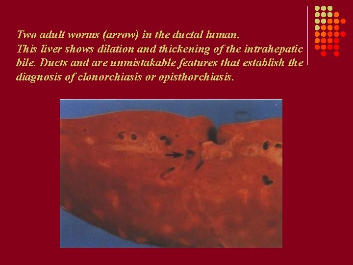 Two adult worms (arrow) in the ductal luman. This liver shows dilation and thickening Two adult worms (arrow) in the ductal luman. This liver shows dilation and thickening