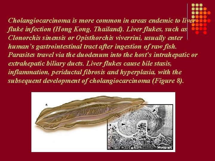 Cholangiocarcinoma is more common in areas endemic to liver fluke infection (Hong Kong, Thailand). Cholangiocarcinoma is more common in areas endemic to liver fluke infection (Hong Kong, Thailand).